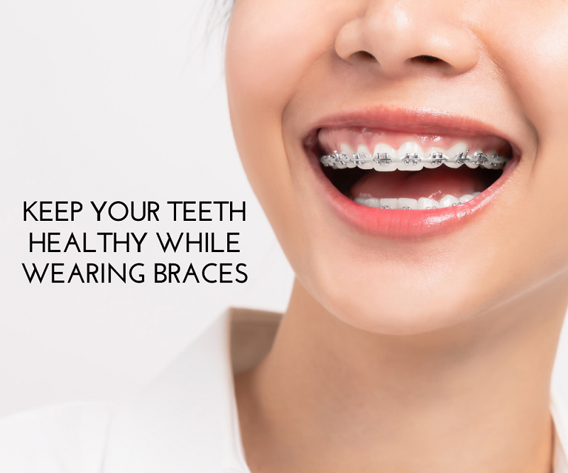 Keep Your Teeth Healthy While Wearing Braces